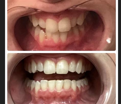smiledirectclub results|smile direct club bad results.